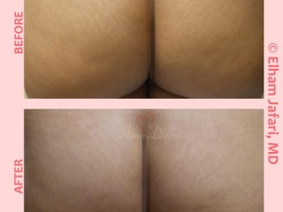 Treatment of stretch marks with Fractional CO2 laser (CO2 laser skin resurfacing)