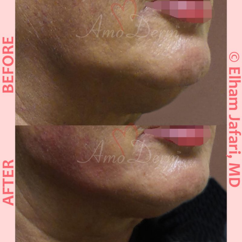 Jawline contouring and restoration with fillers