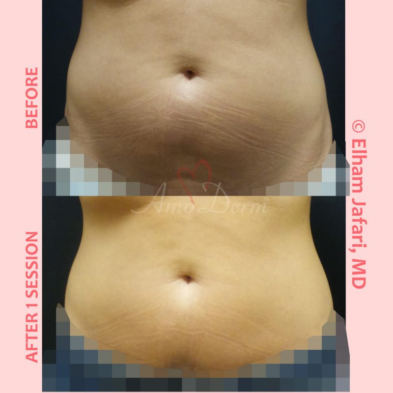 SculpSure Stubborn Fat Reduction