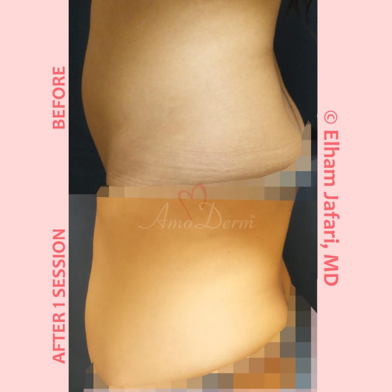 SculpSure Stubborn Fat Reduction