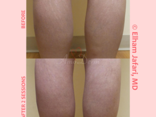 Treatment of stretch marks with Fractional CO2 laser (CO2 laser skin resurfacing)