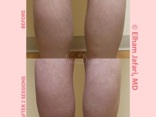 Treatment of stretch marks with Fractional CO2 laser (CO2 laser skin resurfacing)