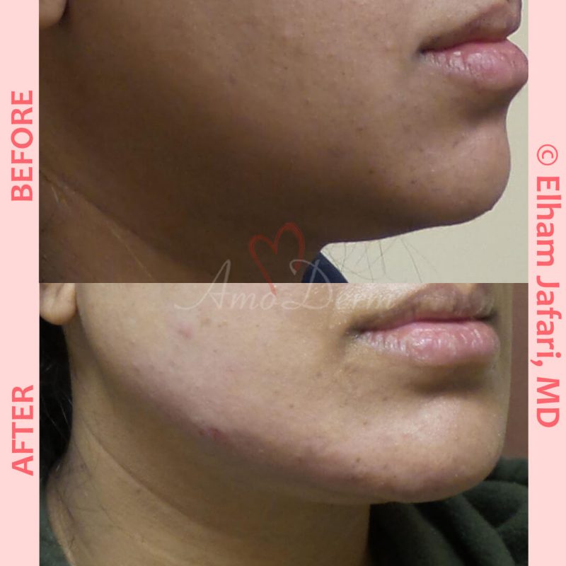 Jawline contouring and restoration with fillers