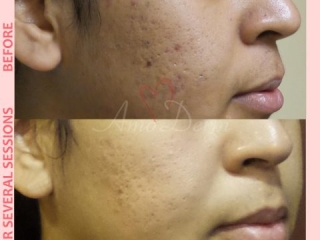 Treatment of acne scarring and other types of scars with micro-needling