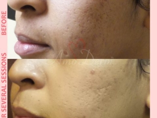 Treatment of acne scarring and other types of scars with micro-needling