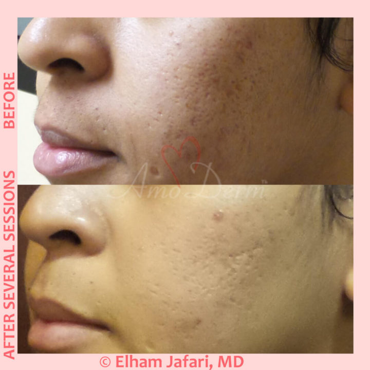 Treatment of acne scarring and other types of scars with micro-needling