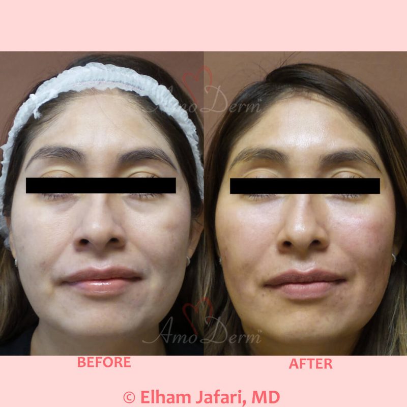 Treatment of nasolabial folds, marionette lines, dark circles under eyes and cheek restoration