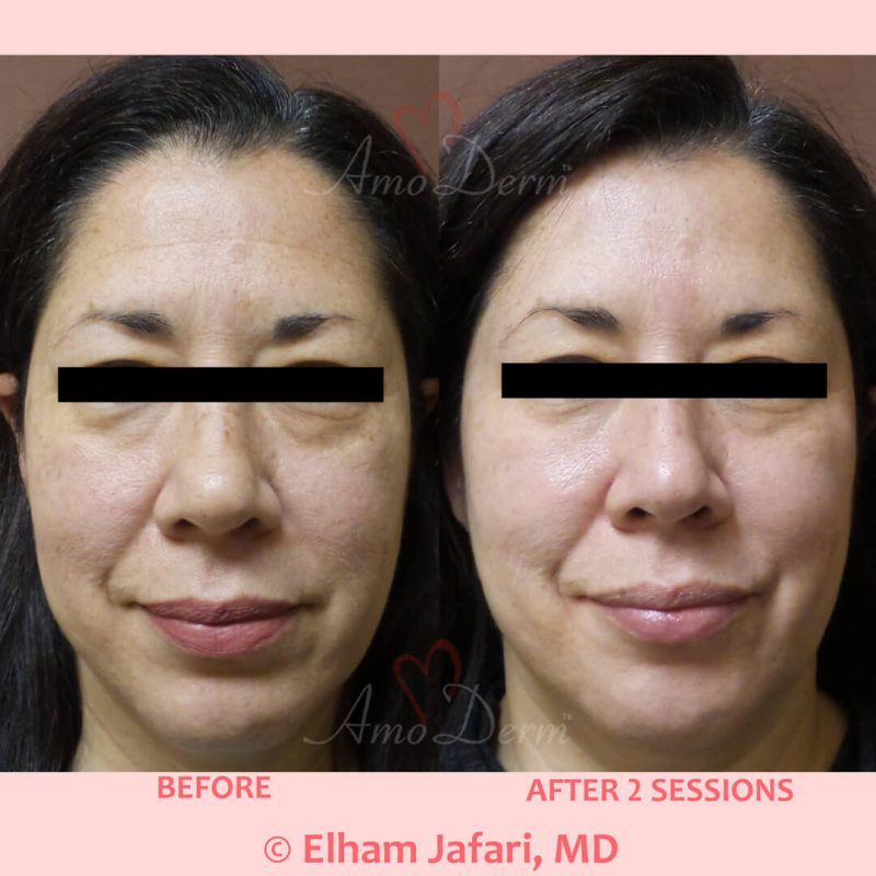 Microlaser Peel - Erbium laser skin resurfacing