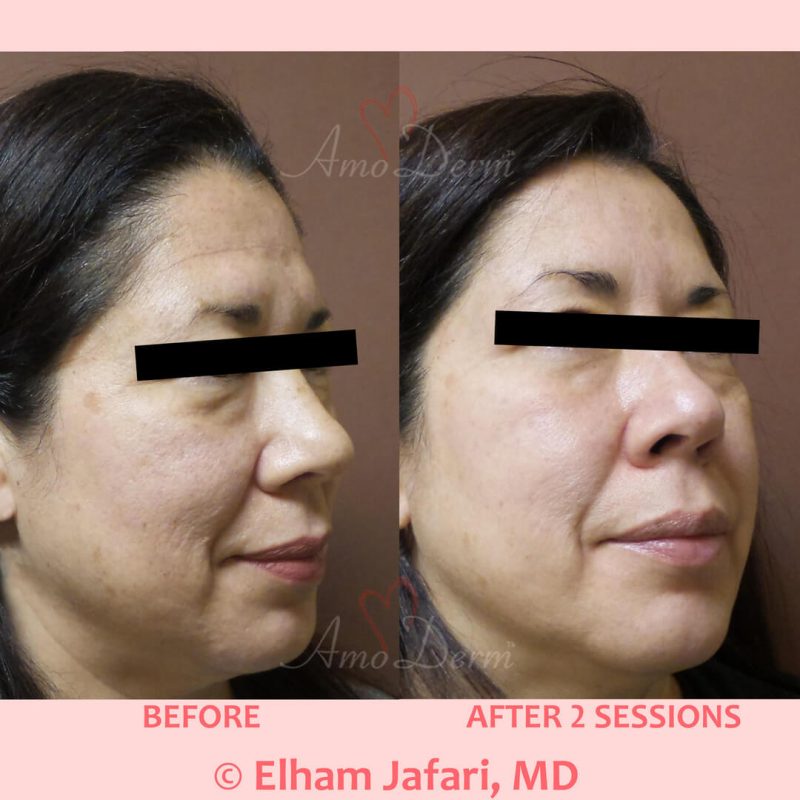 Microlaser Peel - Erbium laser skin resurfacing