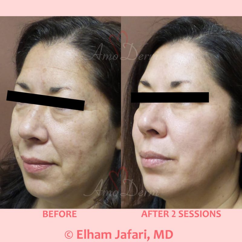 Microlaser Peel - Erbium laser skin resurfacing
