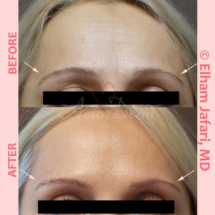 Non-surgical eyebrow lift and treatment of lines in forehead