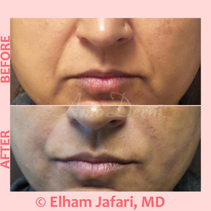 Treatment of nasolabial folds as part of non-surgical facelift