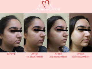 Treatment of acne scars with Fractional CO2 laser skin resurfacing