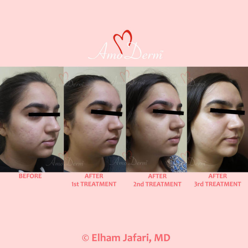 Treatment of acne scars with Fractional CO2 laser skin resurfacing