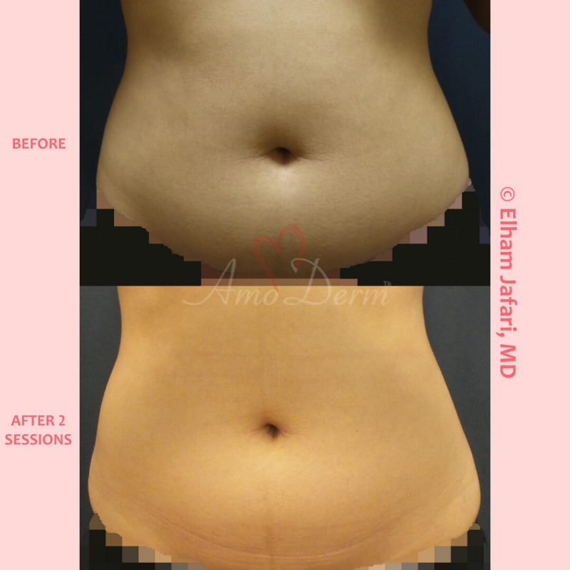 SculpSure Stubborn Fat Reduction