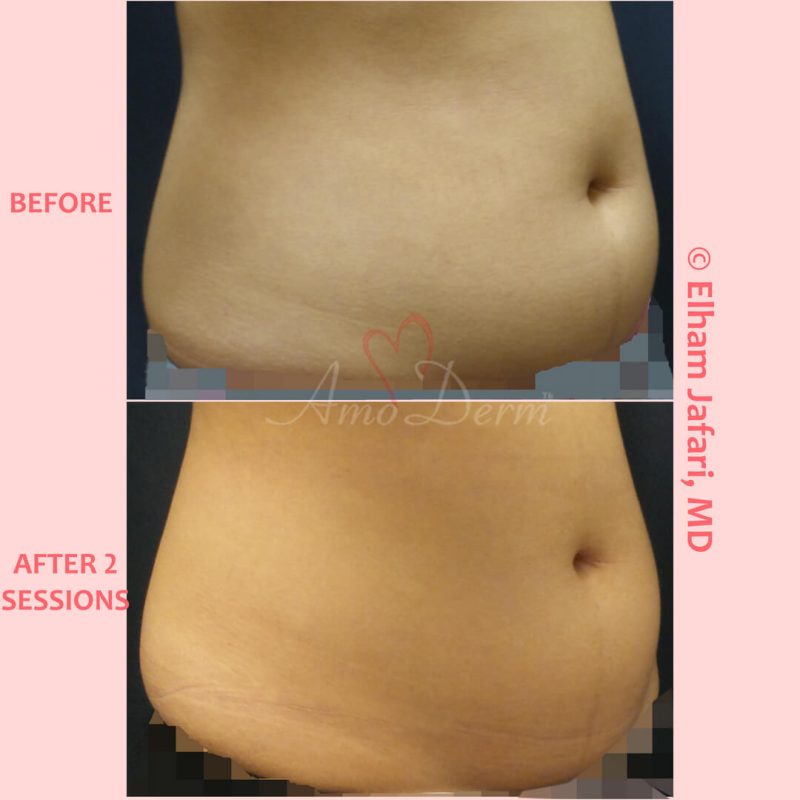 SculpSure Stubborn Fat Reduction