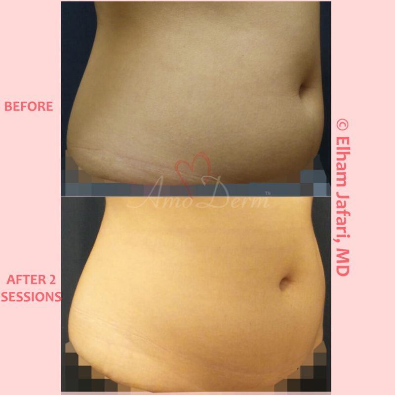 SculpSure Stubborn Fat Reduction