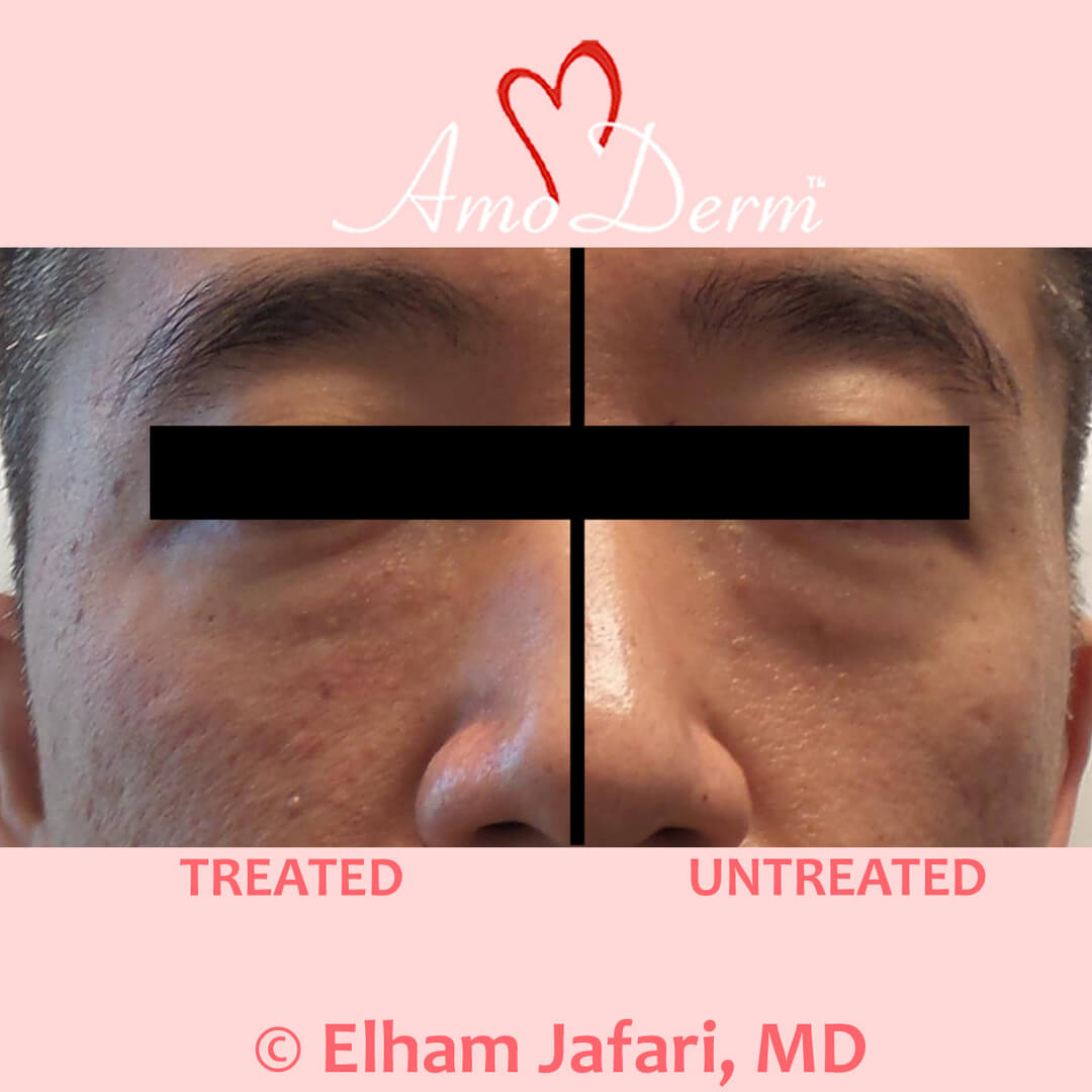 Treat dark circles & bags under eyes using fillers & lasers