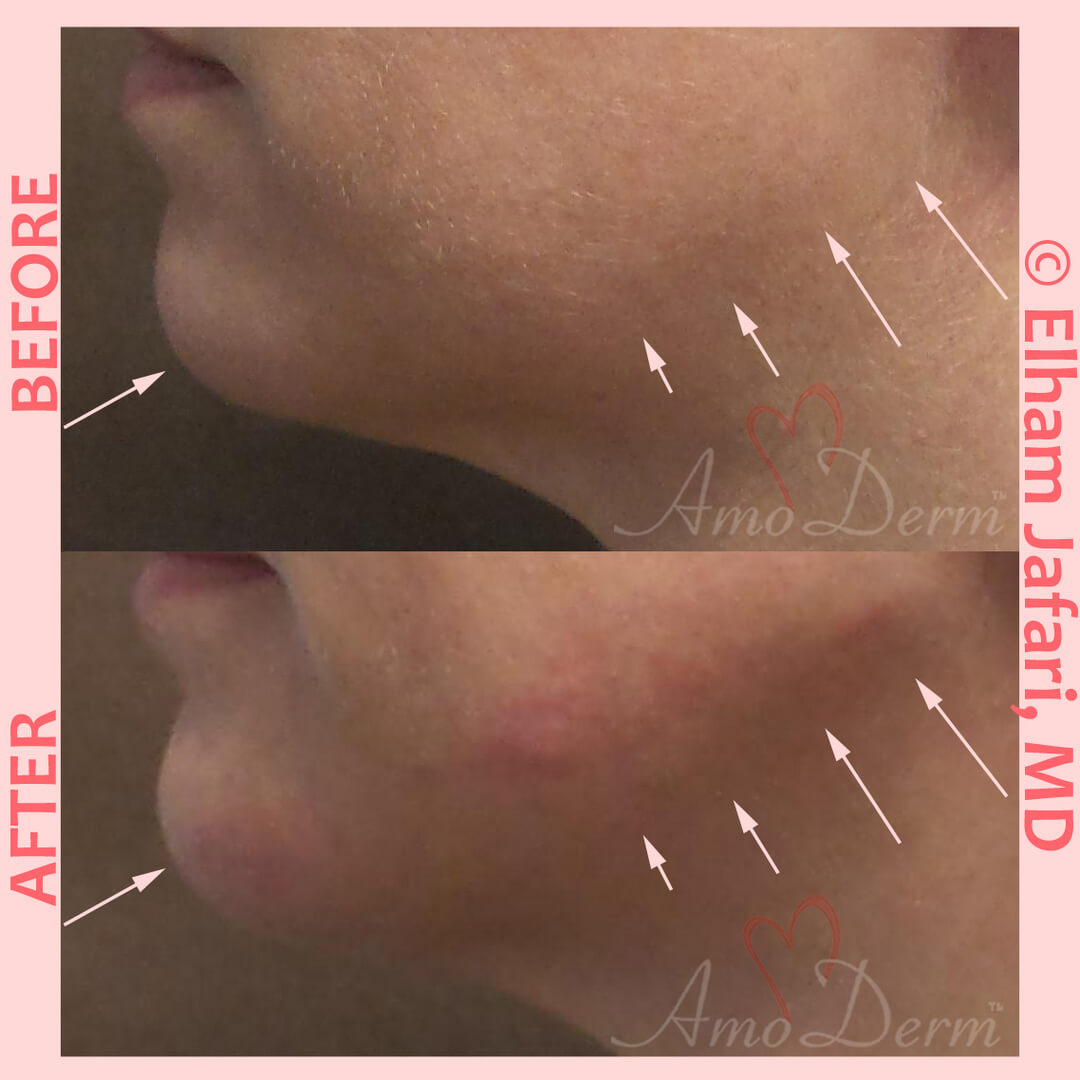 Jaw Sculpting Common Concerns and Cosmetic Procedures