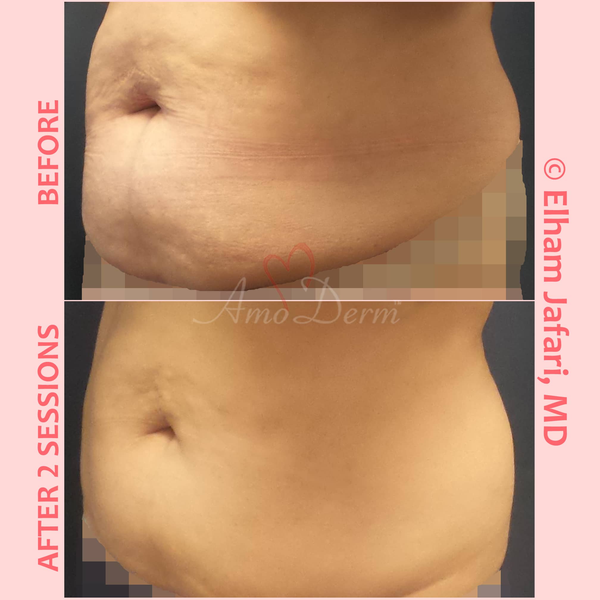 SculpSure  Non-Surgical Body Contouring Treatments in Irvine