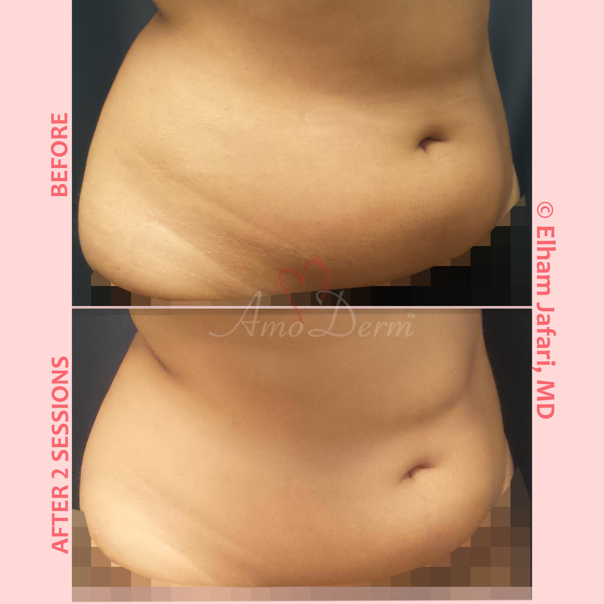 SculpSure  Non-Surgical Body Contouring Treatments in Irvine