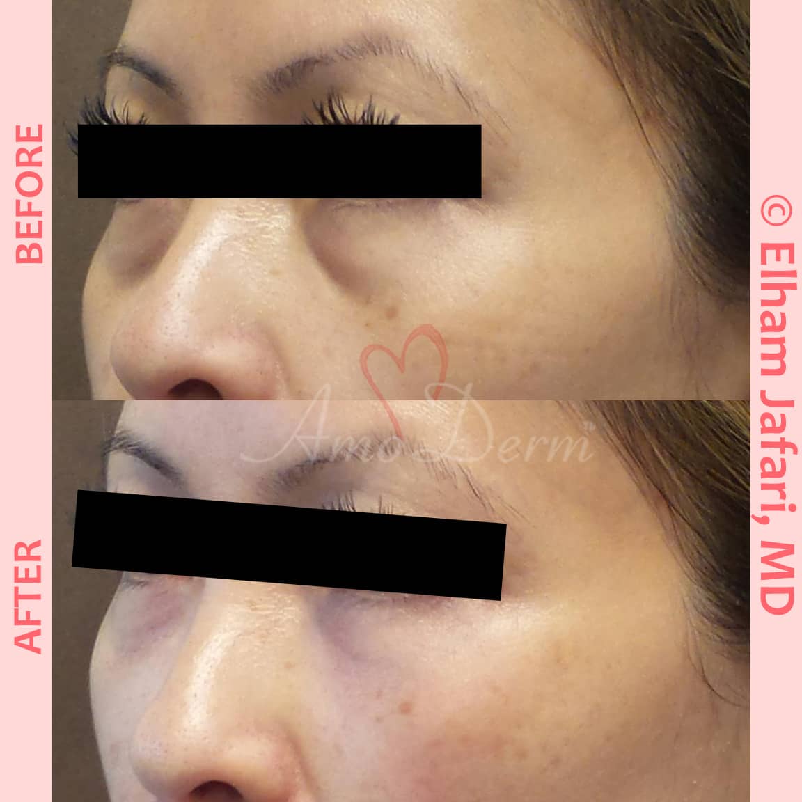 Treat dark circles & bags under eyes using fillers & lasers