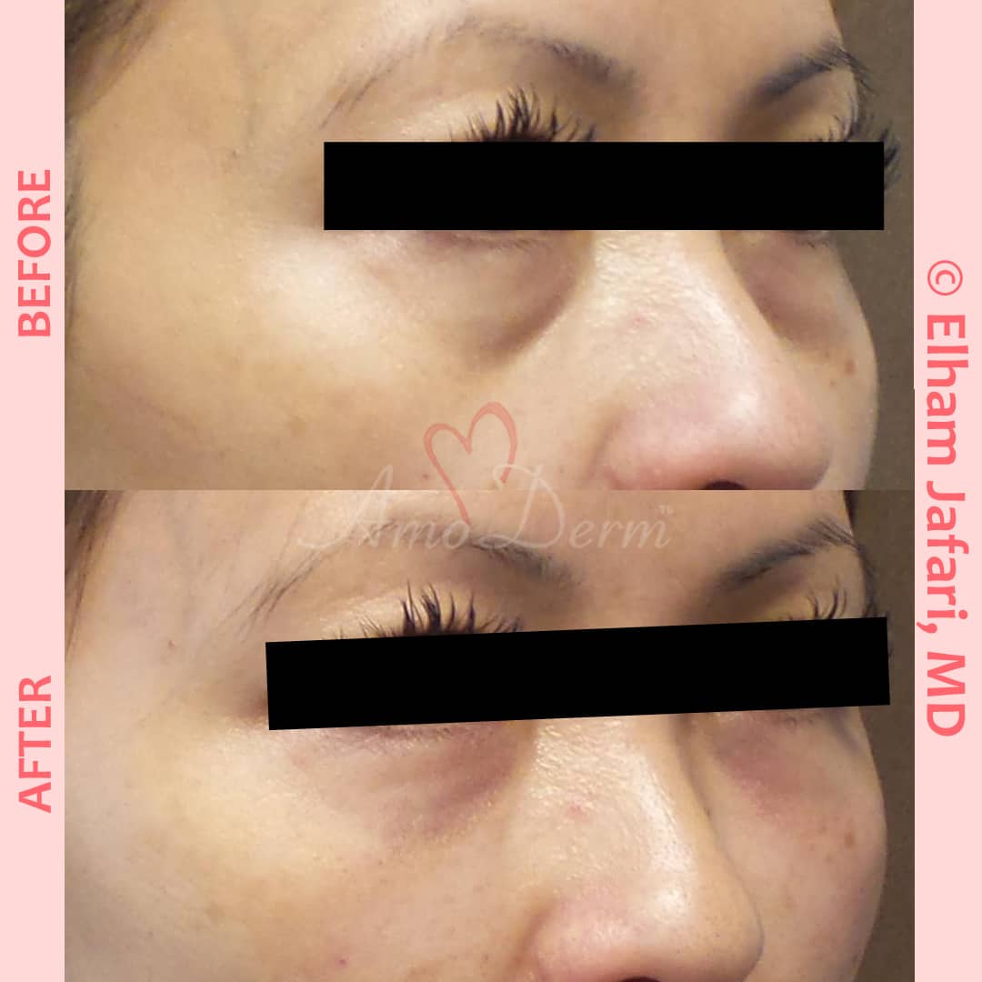 Treat dark circles & bags under eyes using fillers & lasers