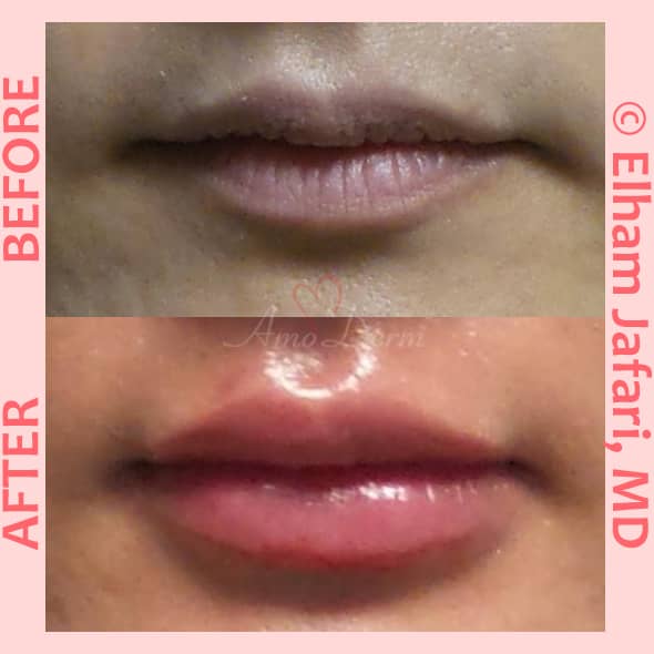 Not known Details About How Much Are Lip Fillers (And More Faqs) • The Gist By ...  thumbnail