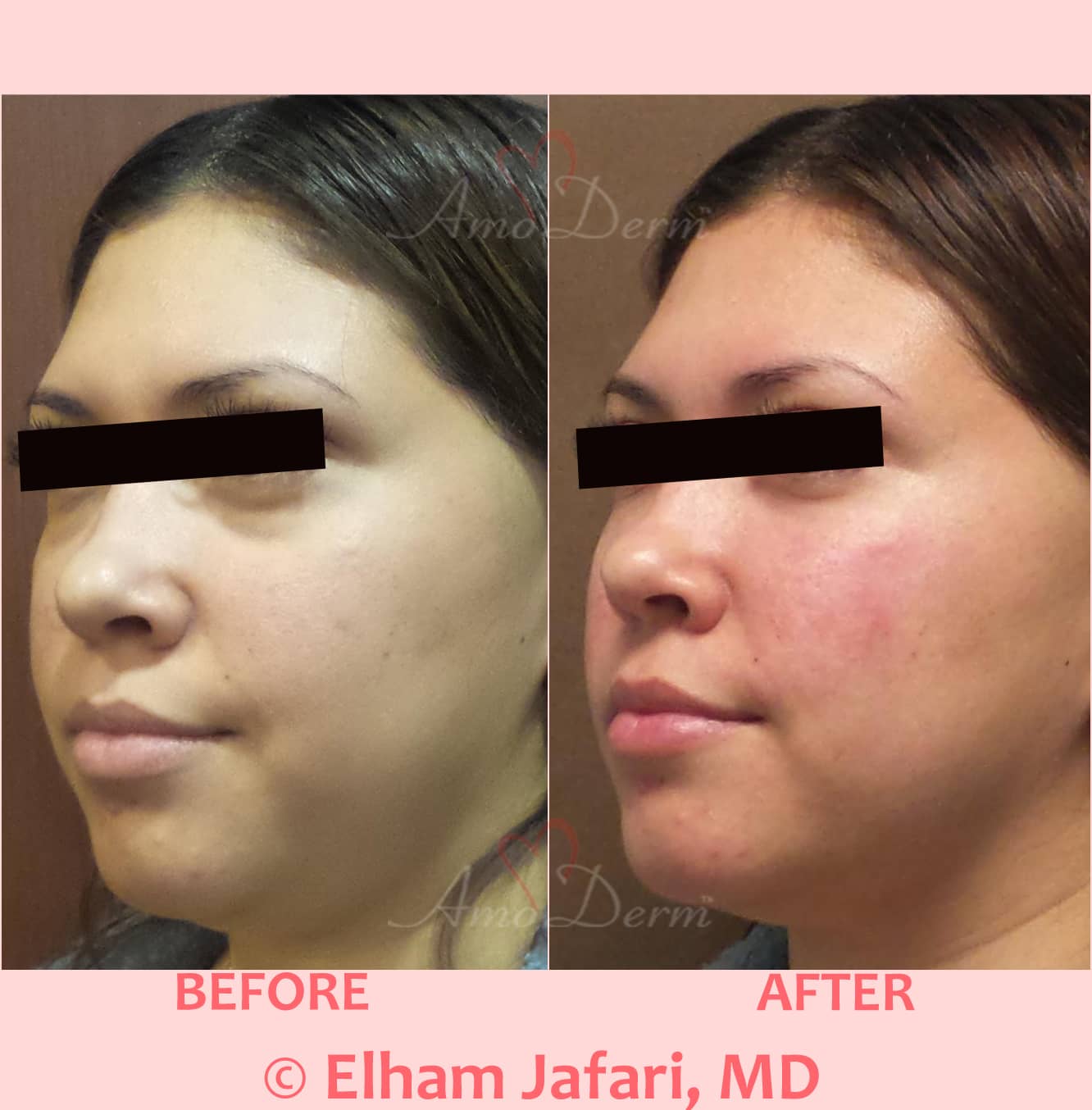 Treat dark circles & bags under eyes using fillers & lasers