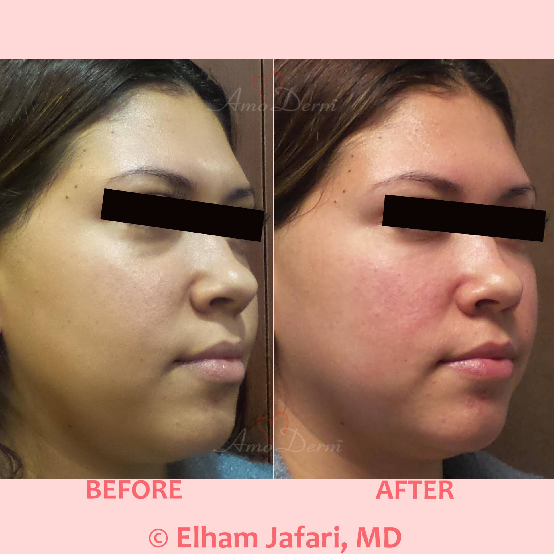 Treat dark circles & bags under eyes using fillers & lasers