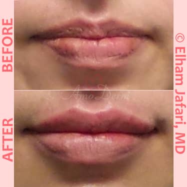 Getting My Lip Injections - Revive Face,body,skin - Orange County ... To Work thumbnail