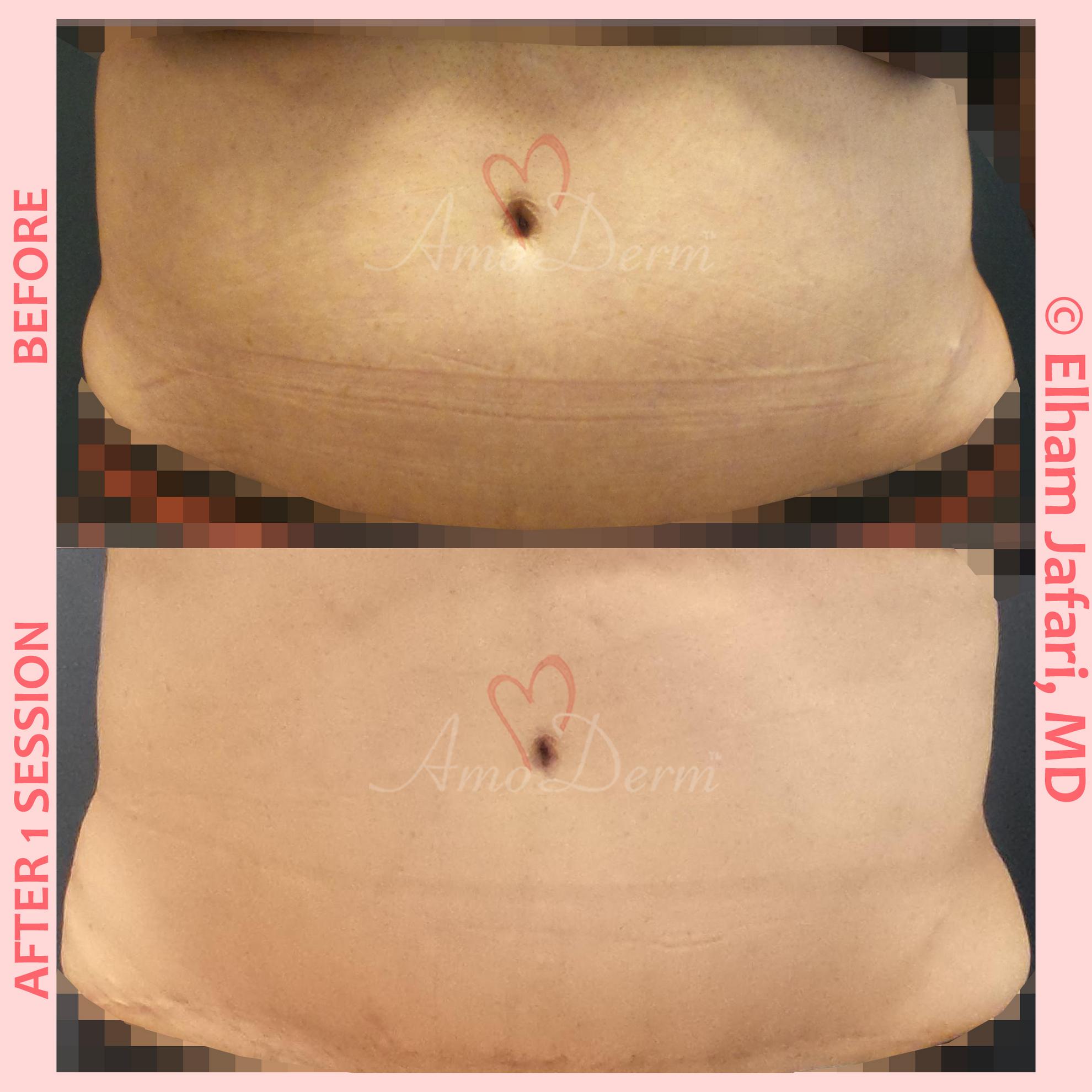 SculpSure  Non-Surgical Body Contouring Treatments in Irvine