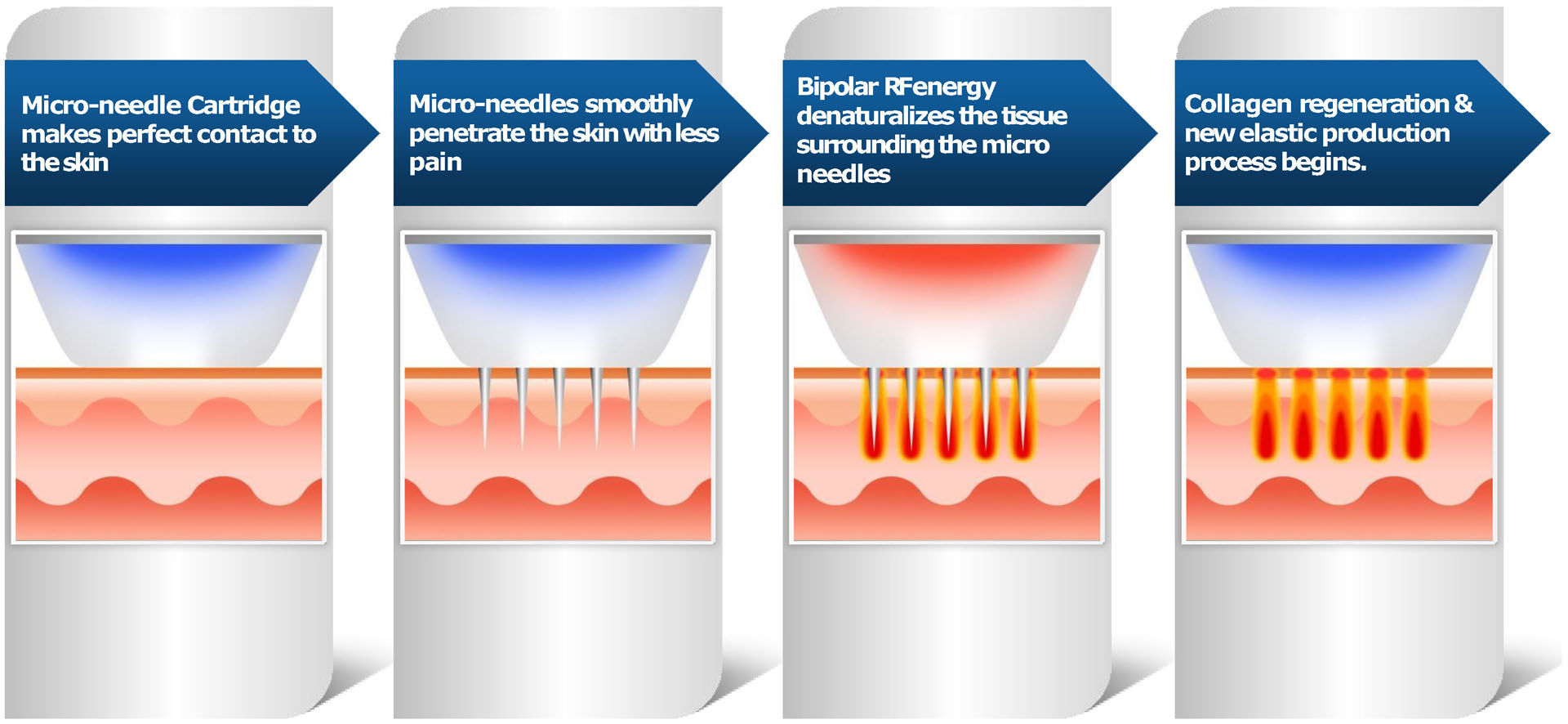 How RF Microneedling is working