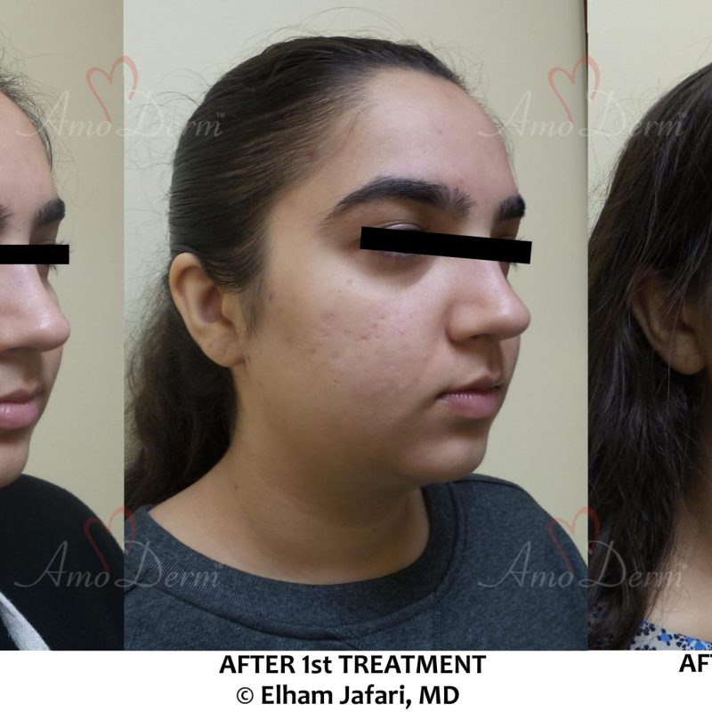 Treatment of acne scars with Fractional CO2 laser skin resurfacing