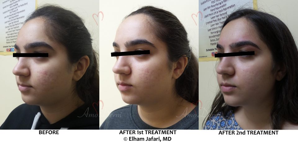 Treatment of acne scars with Fractional CO2 laser skin resurfacing