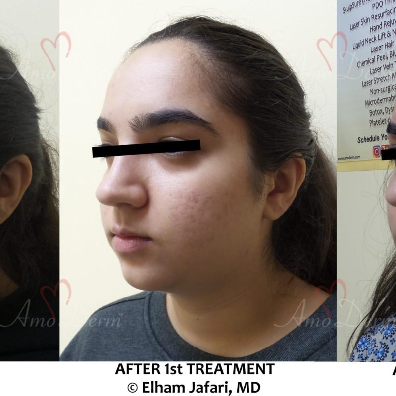 Treatment of acne scars with Fractional CO2 laser skin resurfacing