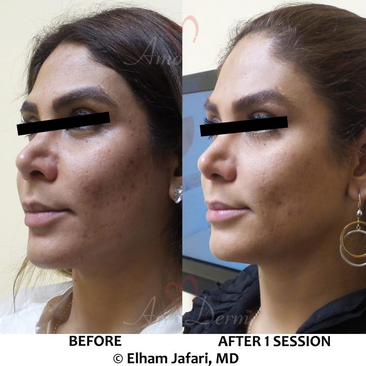 Treatment of acne scars with Fractional CO2 laser skin resurfacing