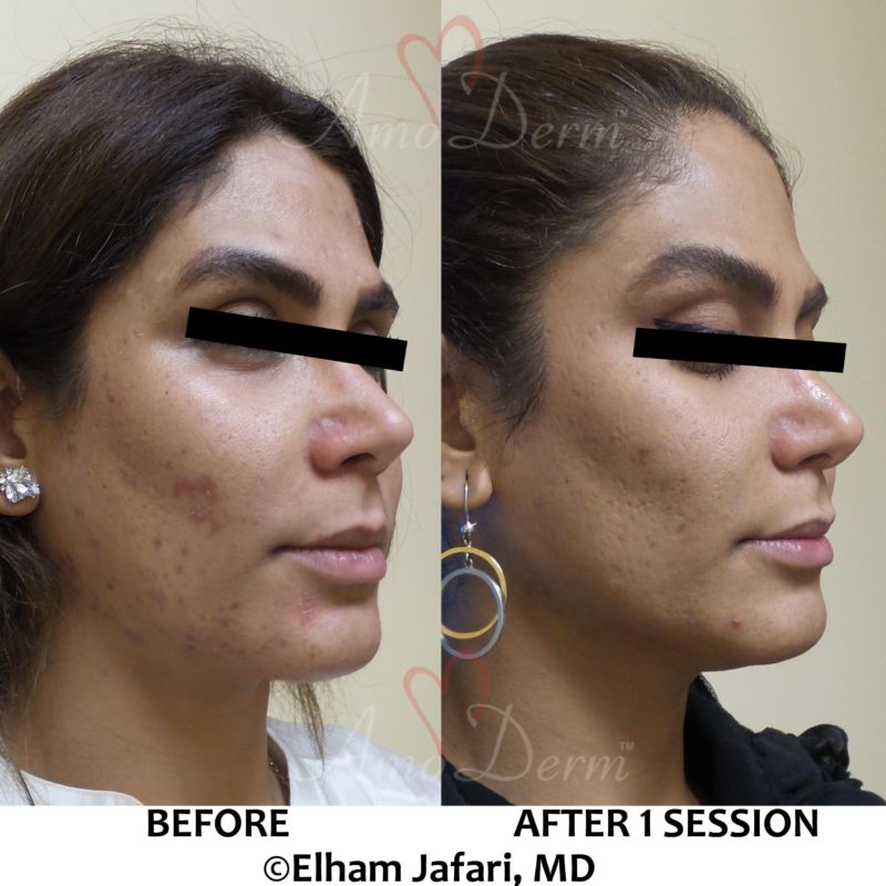 Treatment of acne scars with Fractional CO2 laser skin resurfacing