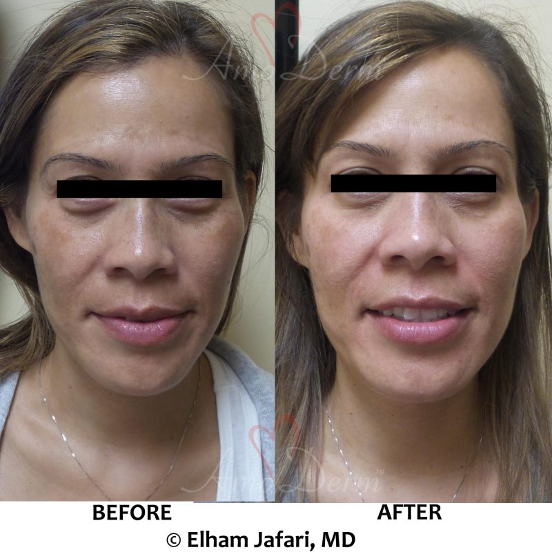 Microlaser Peel - Erbium laser skin resurfacing