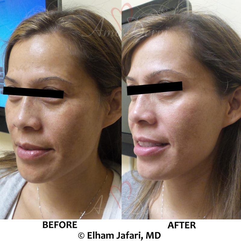 Microlaser Peel - Erbium laser skin resurfacing