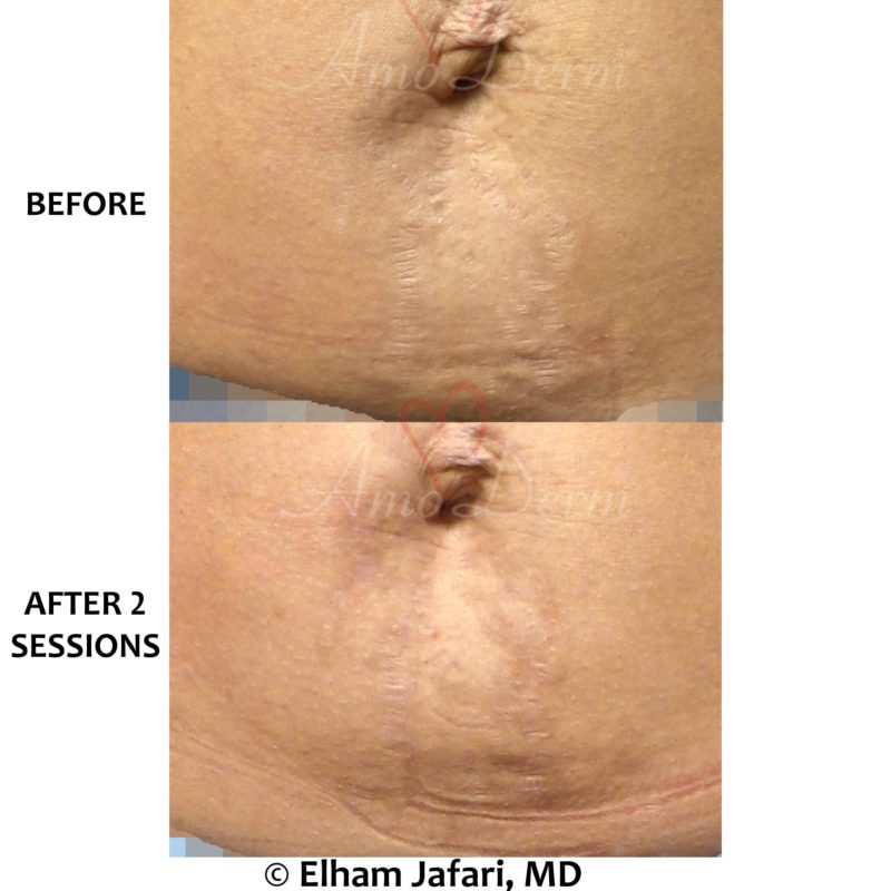 Treatment of stretch marks with Fractional CO2 laser (CO2 laser skin resurfacing)