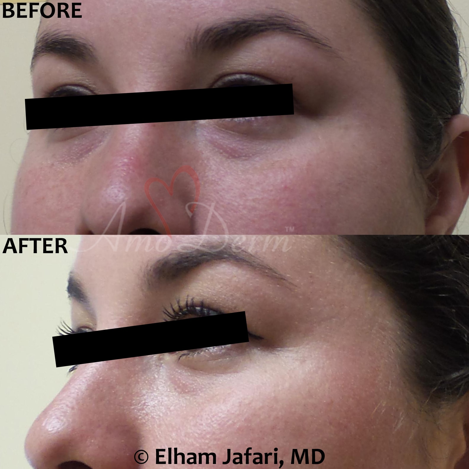 Treat dark circles & bags under eyes using fillers & lasers
