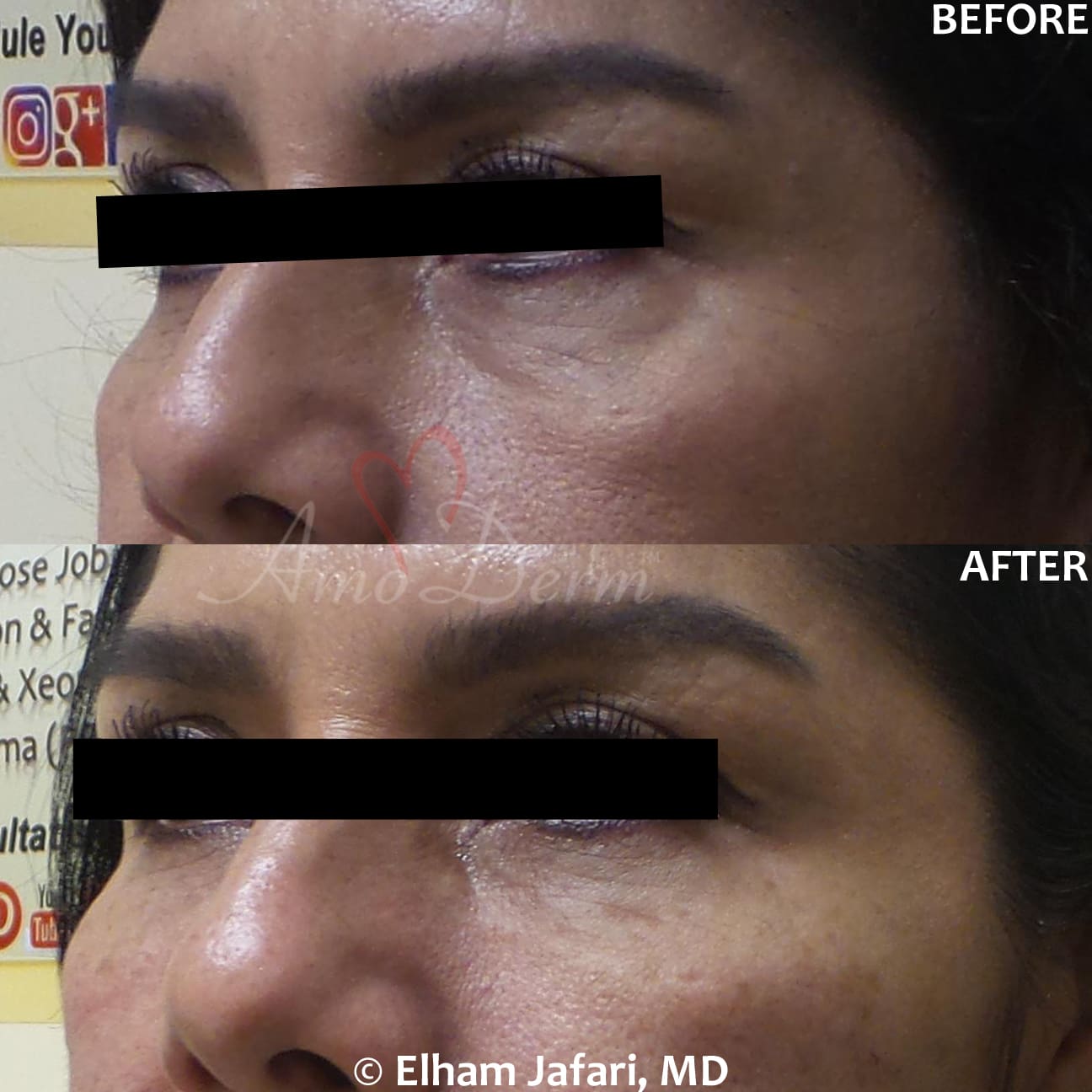 Treat dark circles & bags under eyes using fillers & lasers