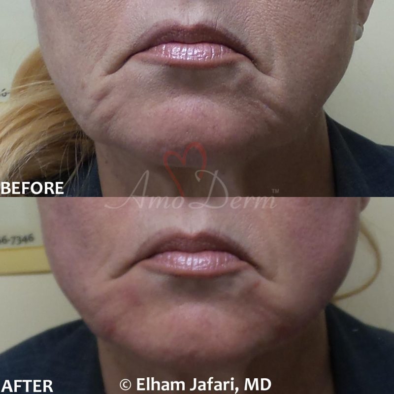 Filler and PDO thread lift for jawline Filler and PDO thread lift for jawline