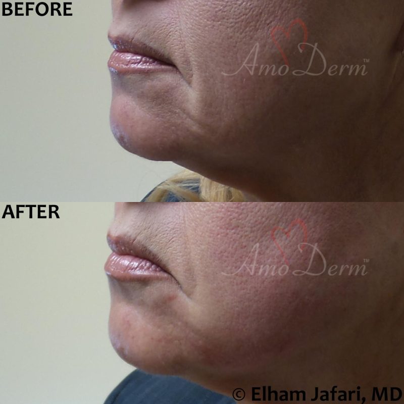 Filler and PDO thread lift for jawline Filler and PDO thread lift for jawline