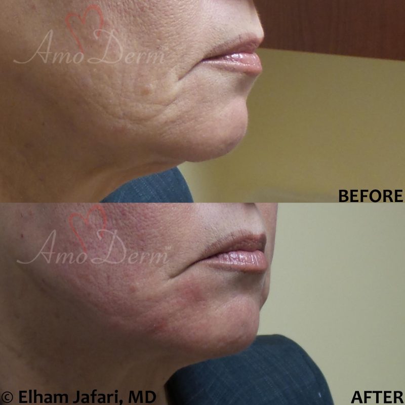 Filler and PDO thread lift for jawline Filler and PDO thread lift for jawline