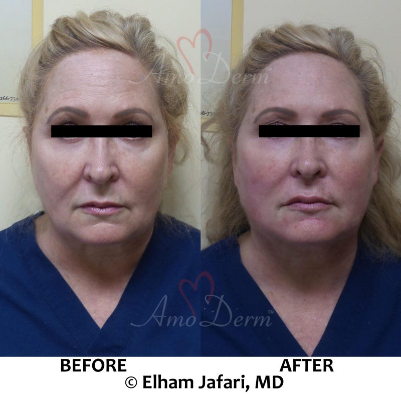 Liquid Facelift with PDO threads Liquid Facelift with PDO threads & filler injection in cheeks and under the eyes