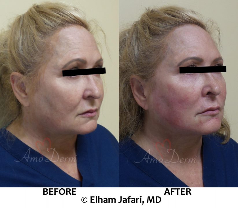 Liquid Facelift with PDO threads & filler injection in cheeks and under the eyes