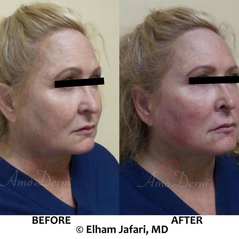Liquid Facelift with PDO threads Liquid Facelift with PDO threads & filler injection in cheeks and under the eyes