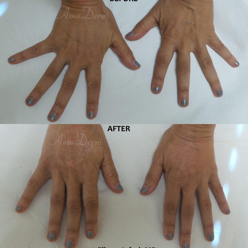 Hand rejuvenation with dermal filler injection